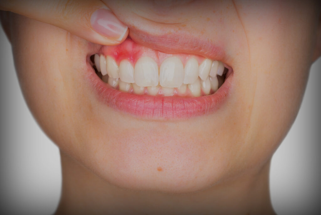 Peri-implantitis tedavisi ve implant çevresi diş eti hastalığı