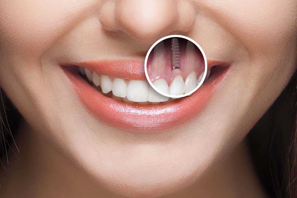 Dental implant tedavisi, eksik dişlerin yerine çene kemiğine yerleştirilen yapay diş kökleriyle kalıcı ve estetik bir çözüm sunar.
