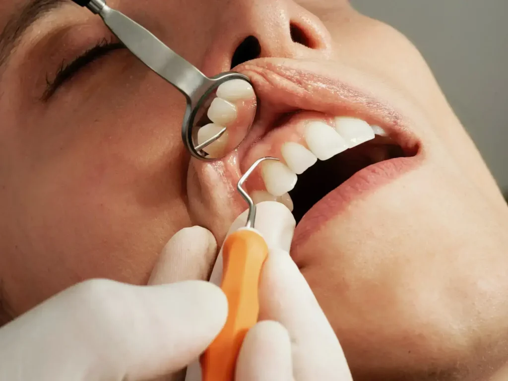 Periodontal hastalık tedavisinde uygulanan diş eti flep operasyonu ve kemik tozu uygulaması.